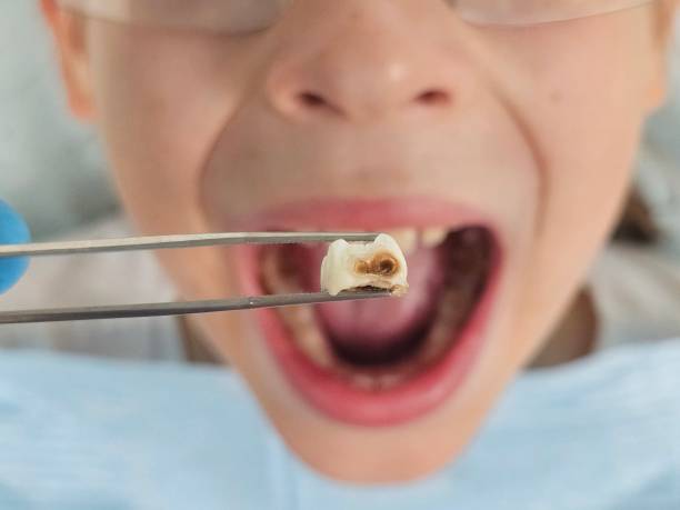 Best Urgent Care for Lost Fillings or Crowns in Frederic, WI